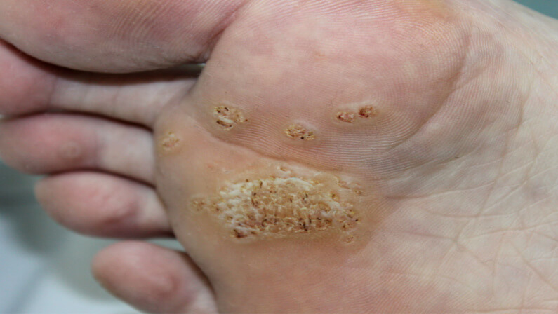Plantar warts build up on feet