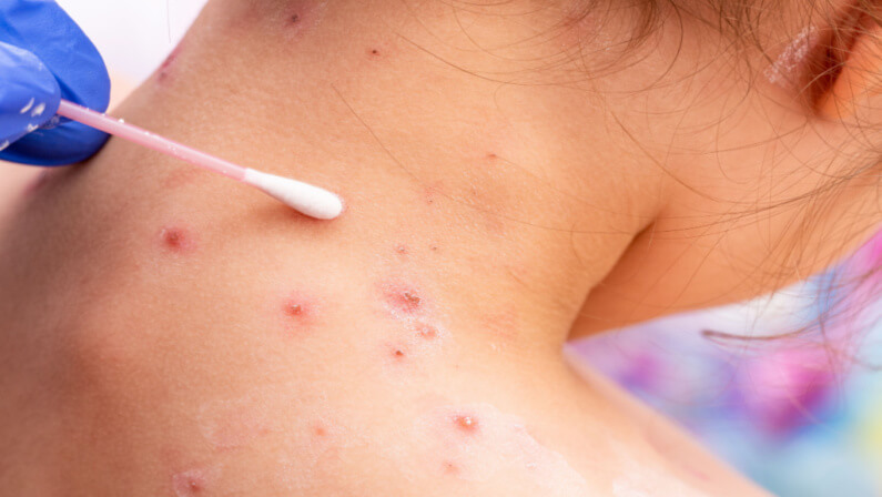Chickenpox on a woman's skin on her back