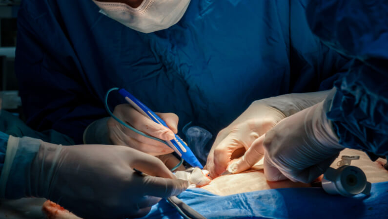 Patient undergoing electrosurgery
