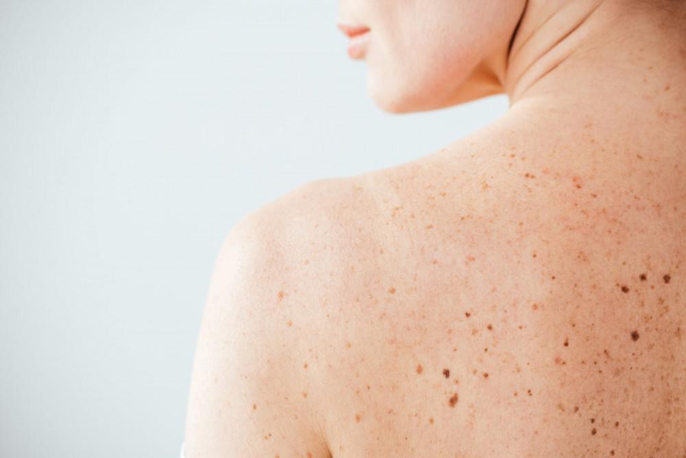 What are dark spots on skin and How Can You Treat Them?