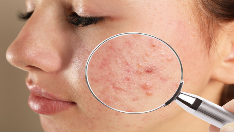 Acne on a woman's face being checked using a magnifying glass