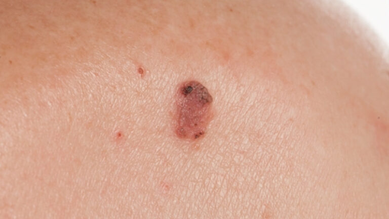 close up of Basal Cell Carcinoma skin cancer specialist dermatology treatment with doctor fakouri in texas