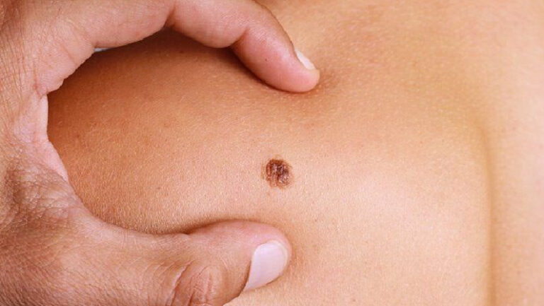 close up of Melanoma spot skin cancer specialist dermatology treatment with doctor fakouri in texas