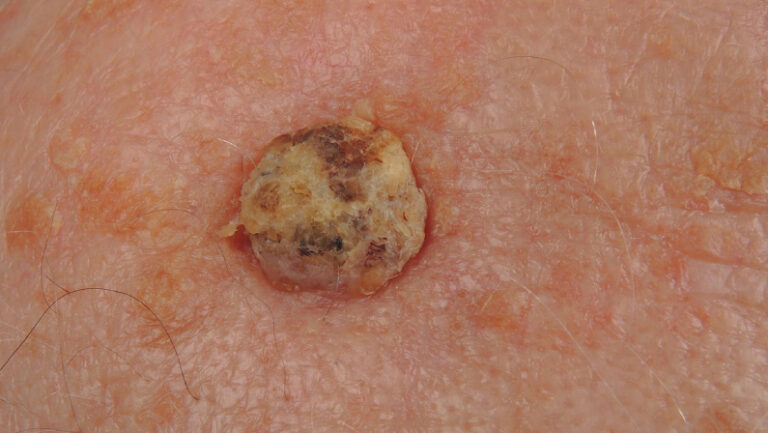 close up of Squamous Cell Carcinoma skin cancer specialist dermatology treatment with doctor fakouri in texas
