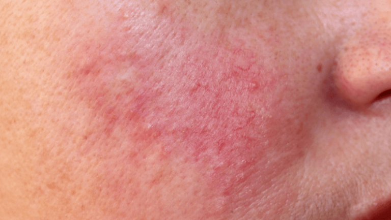 close up of cheek with vascular rosacea skin cancer specialist dermatology treatment with doctor fakouri in texas