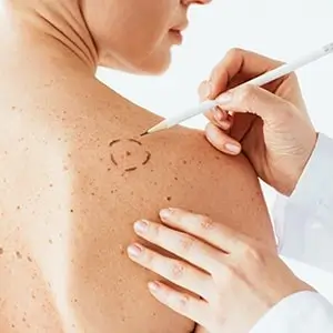 close up of doctor examining womans shoulder with melanoma skin cancer specialist dermatology treatment with doctor fakouri in texas