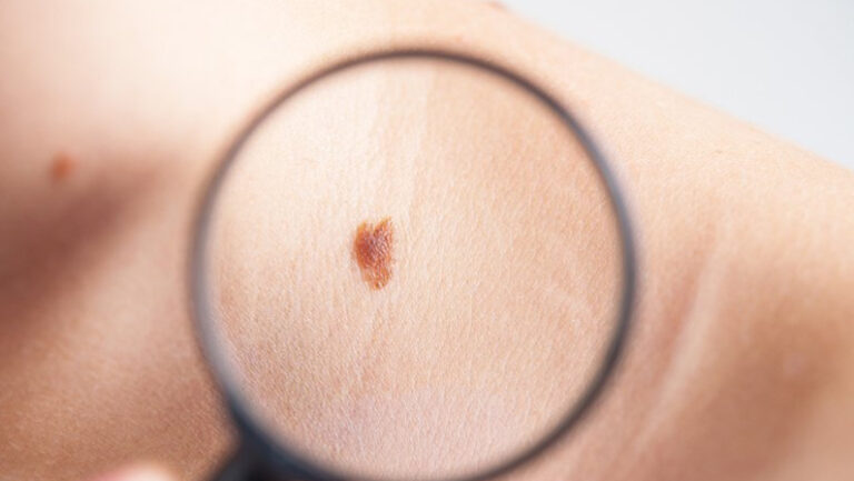 close up of magnifying glass examining mole skin cancer specialist dermatology treatment with doctor fakouri in texas