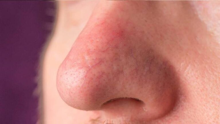 close up of nose with Phymatous rosacea skin cancer specialist dermatology treatment with doctor fakouri in texas