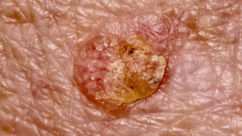 close up of skin Actinic Keratosis skin cancer specialist dermatology treatment with doctor fakouri in texas