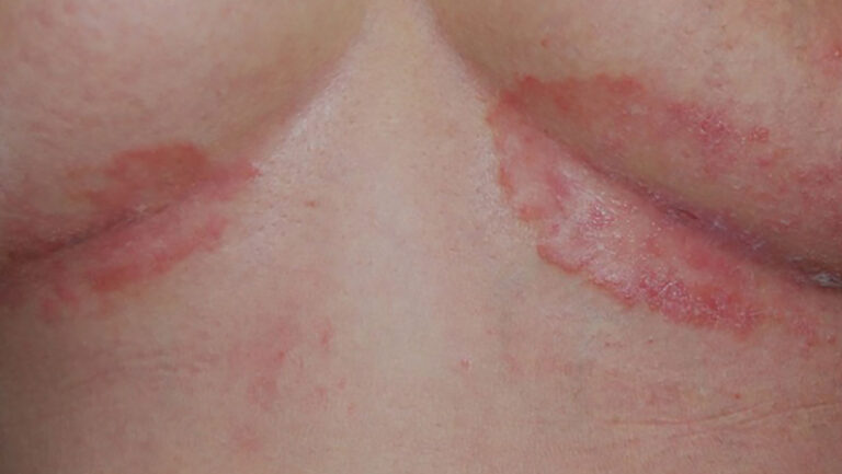 close up of skin under breasts with Inverse psoriasis skin cancer specialist dermatology treatment with doctor fakouri in texas