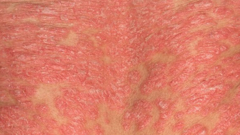 close up of skin with Erythrodermic psoriasis skin cancer specialist dermatology treatment with doctor fakouri in texas