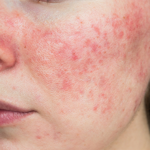 close up of womans cheek with red pigment rosacea skin cancer specialist dermatology treatment with doctor fakouri in texas