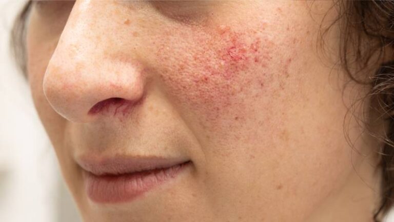 close up of womans face with rosacea skin cancer specialist dermatology treatment with doctor fakouri in texas