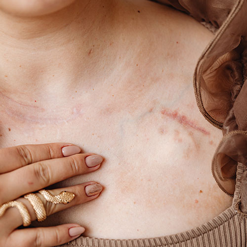 close up of womans hand touching chest with scar skin cancer specialist dermatology treatment with doctor fakouri in texas