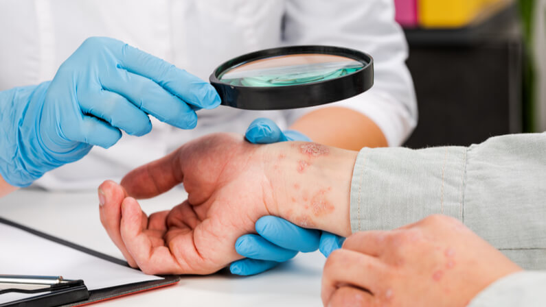 Doctor checking patient with psoriasis problem