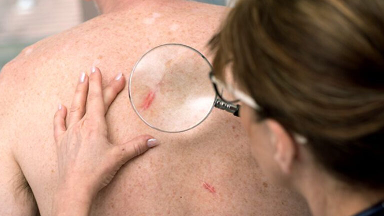 doctor examining skin cancer on mans back skin cancer specialist dermatology treatment with doctor fakouri in texas