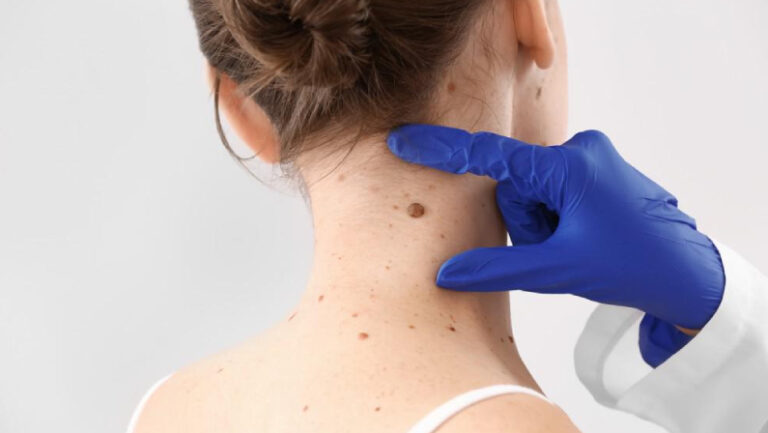 doctor examining womans neck with large mole skin cancer specialist dermatology treatment with doctor fakouri in texas