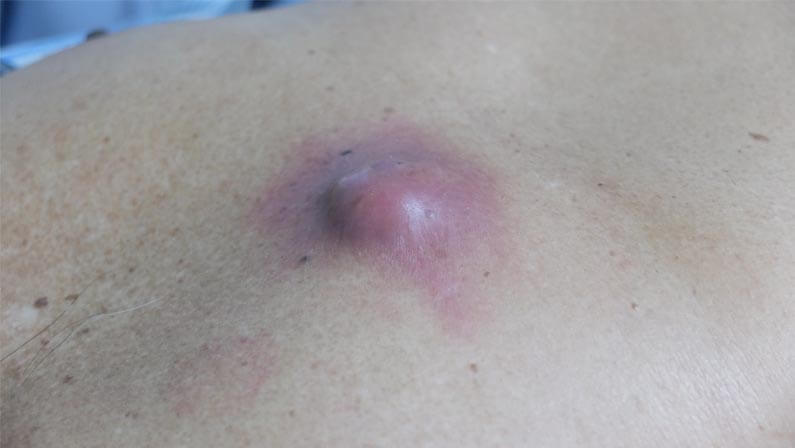 Photo of an infected Sebaceous Hyperplasia