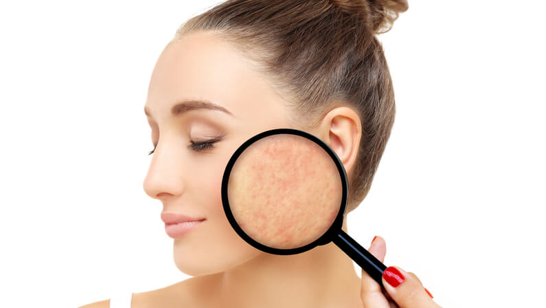 magnified acne scars of a woman skin cancer specialist dermatology treatment with doctor fakouri in texas