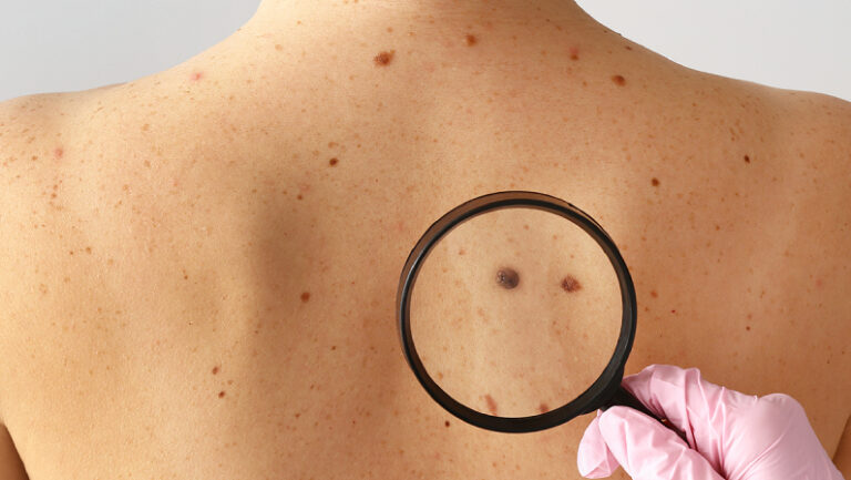 magnifying glass examining moles on back skin cancer specialist dermatology treatment with doctor fakouri in texas
