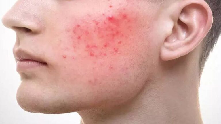 mans cheek with rosacea skin cancer specialist dermatology treatment with doctor fakouri in texas