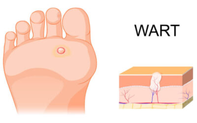 How to Get Rid of Plantar Warts in Most Effective Ways