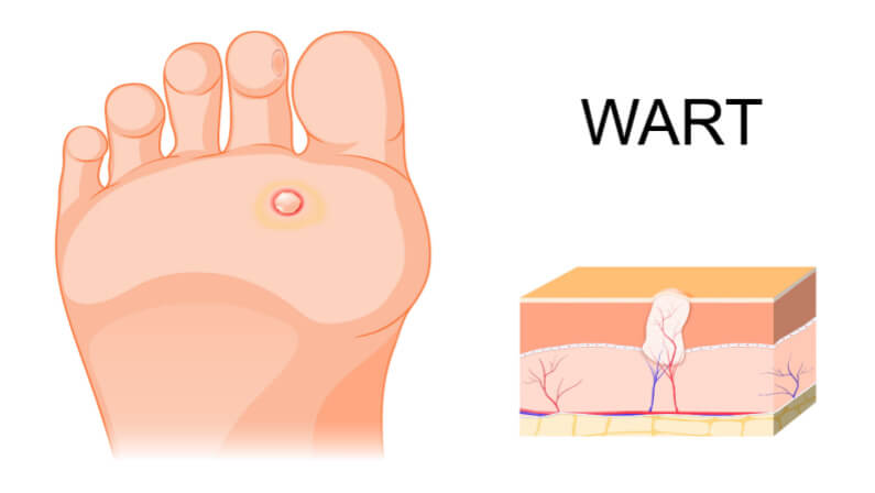 How To Get Rid Of Plantar Warts In Most Effective Ways Skin Cancer 