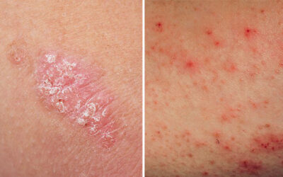 Difference Between Eczema and Psoriasis