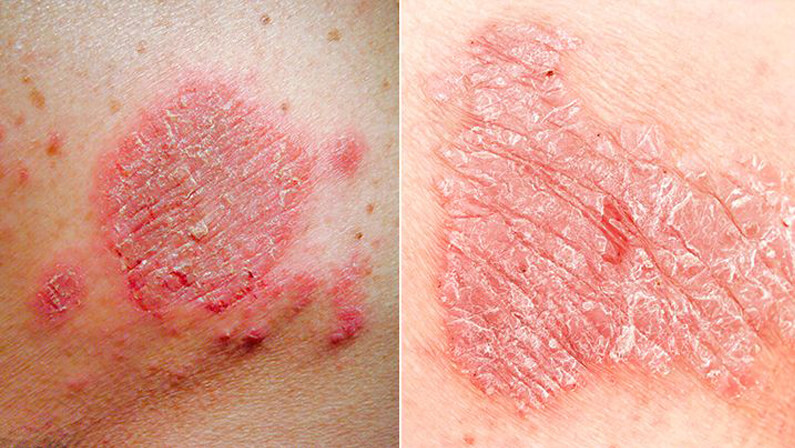 Psoriasis and eczema difference in photo