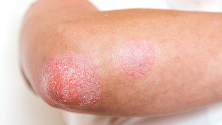red patchy elbow withpsoriasis skin cancer specialist dermatology treatment with doctor fakouri in texas