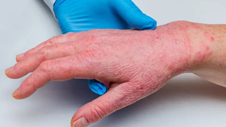 red scally hand with psoriasis skin cancer specialist dermatology treatment with doctor fakouri in texas