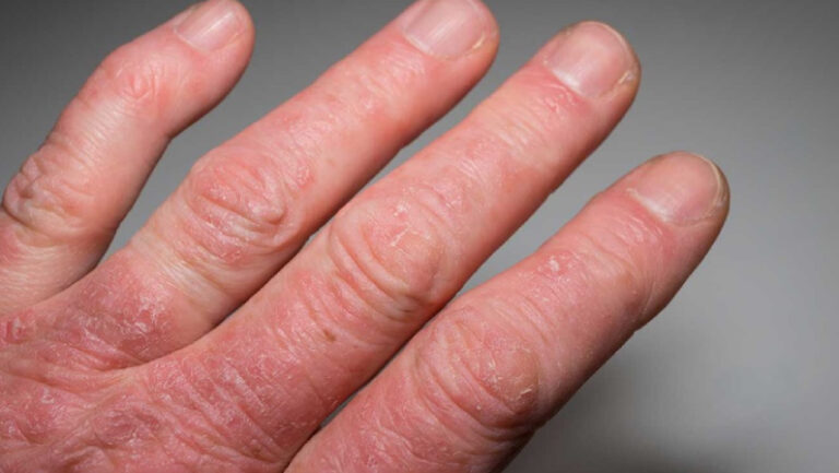 red scaly fingers with Psoriatic arthritis skin cancer specialist dermatology treatment with doctor fakouri in texas