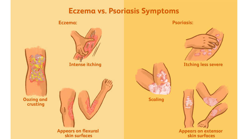 Illustration of symptoms psoriasis vs eczema