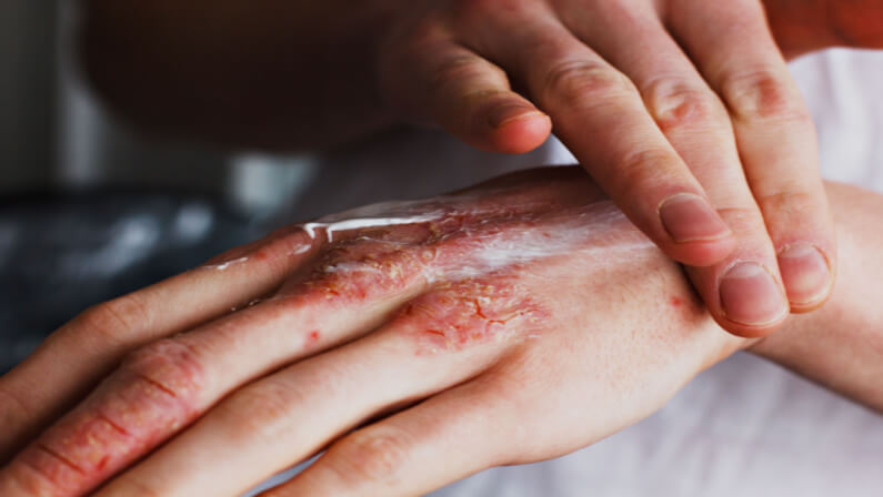 Patient applying topical medicines to treat psoriasis in his hands