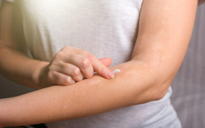 Understanding Eczema: How to Choose the Right Cream for Your Skin Type