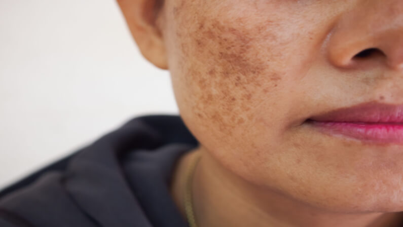 Woman With Dark Spot On Face 