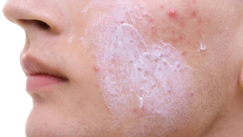 woman with dry skin and cream on face skin cancer specialist dermatology treatment with doctor fakouri in texas