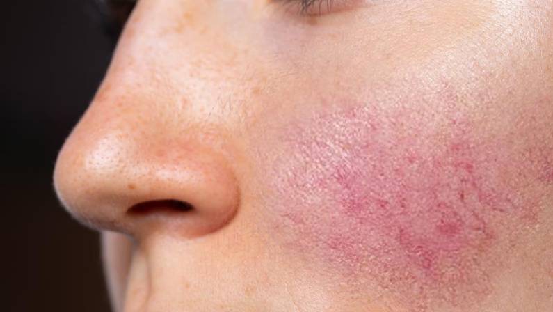 womans cheek with Erythrotelangiectatic rosacea skin cancer specialist dermatology treatment with doctor fakouri in texas