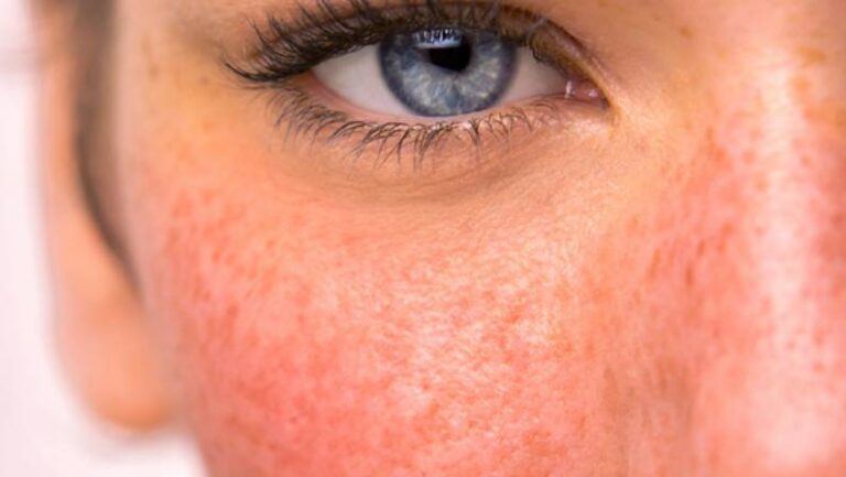 womans eye and cheek with rosacea skin cancer specialist dermatology treatment with doctor fakouri in texas