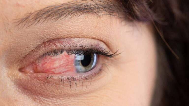 womans eyeball with Ocular rosacea skin cancer specialist dermatology treatment with doctor fakouri in texas