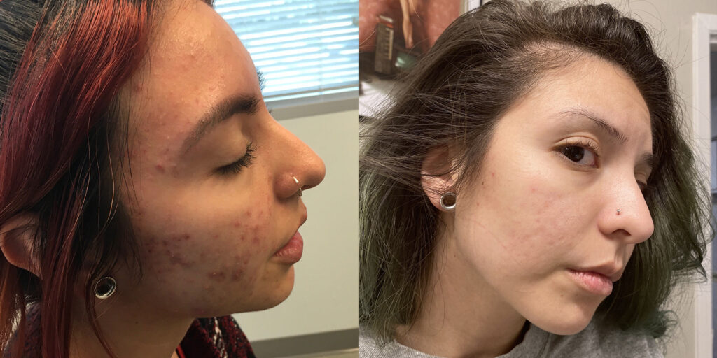 Acne Treatments Before and After Photo by Skin Cancer Specialists in Sugar Land Texas