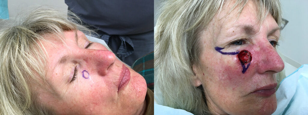 Mohs Surgery Before and After Photo by Skin Cancer Specialists in Sugar Land Texas
