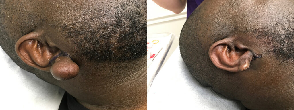 Keloid Excision Before and After Photo by Skin Cancer Specialists in Sugar Land Texas