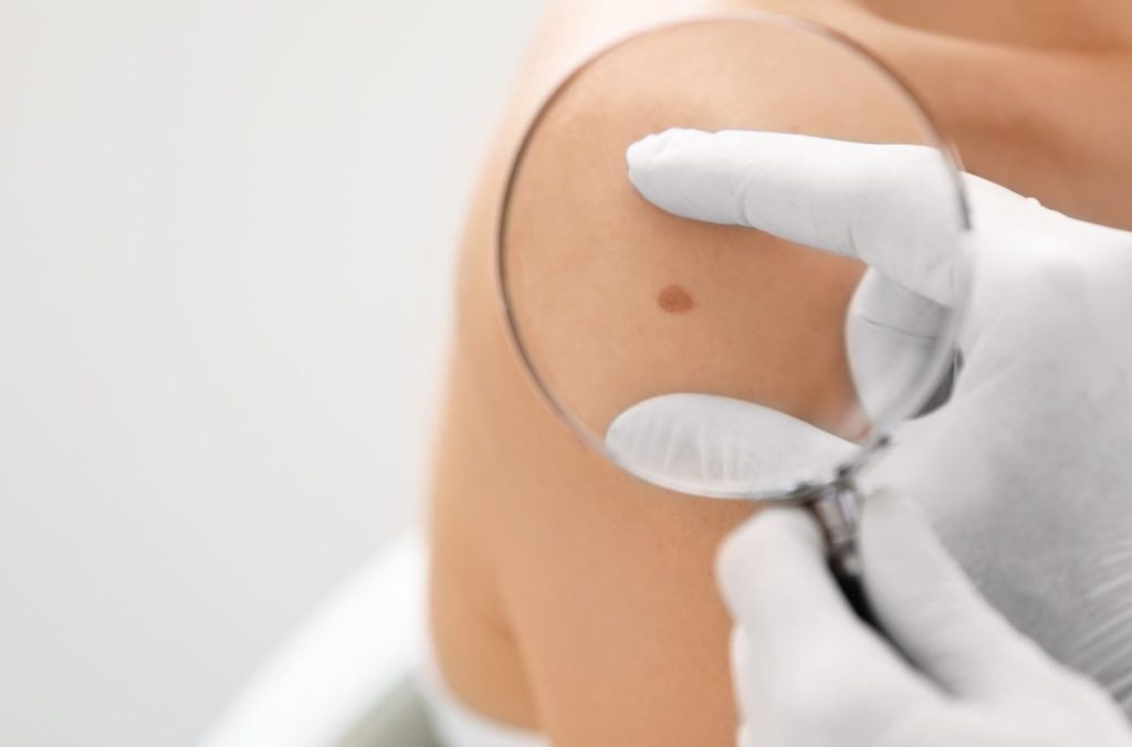 melanoma