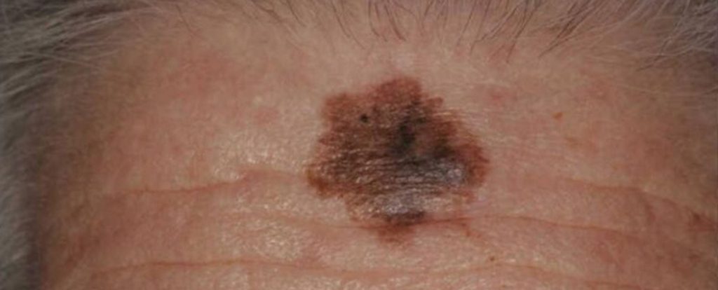 The Ultimate Guide to Understanding Melanoma 4