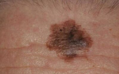 Does Melanoma Metastasize to the Skull?