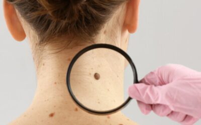 How to Avoid Melanoma: A Complete Guide to Protecting Your Skin